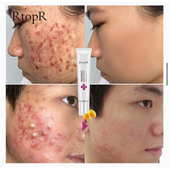 5/ $30 Mango repair acne cream - Picture 3 of 4